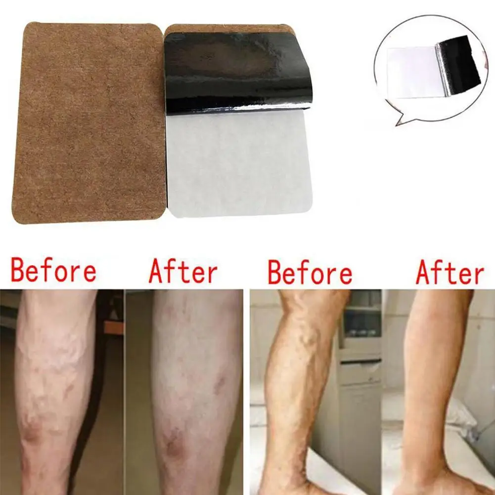 Varicose Veins Herbal Healing Patch Cure and Leg Shoulder Self-heating Waist Plasters Stickers Neck L6F5 |