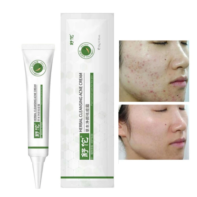 pimple pores removal cream