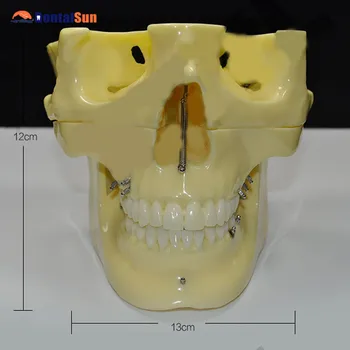 

Dental M2016 Implant Practice Teeth Model