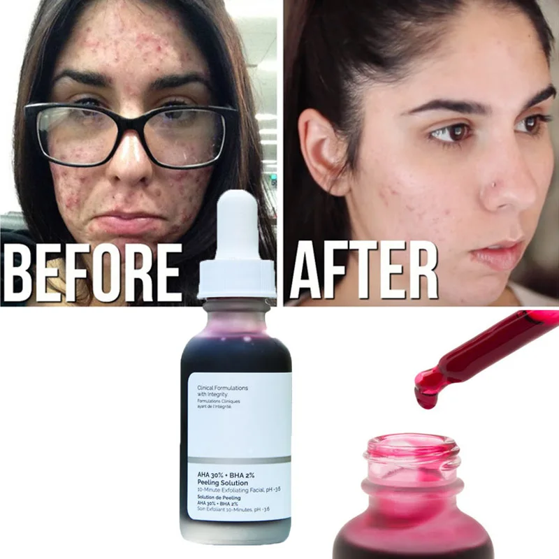 

Acne Mask 10 Minute Exfoliating Mask Facial Serum Remove Acne Scars Whitening Skin Care the Ordinary Aha 30% + Bha 2% Peeling So