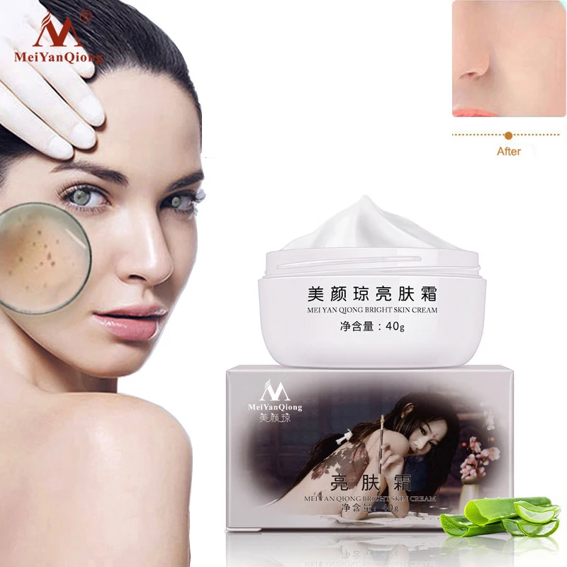 

Strong Effects Powerful Whitening Freckle Cream Remove Melasma Acne Spots Pigment Melanin Moisturizing Face Skin Care 40g 01