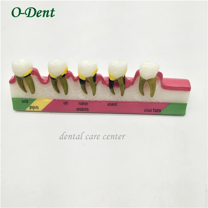 Стоматологическая модель кариеса зубов для корня cannal endodontics пародонтологические патологические болезни ассортирование патологии компарация зубов