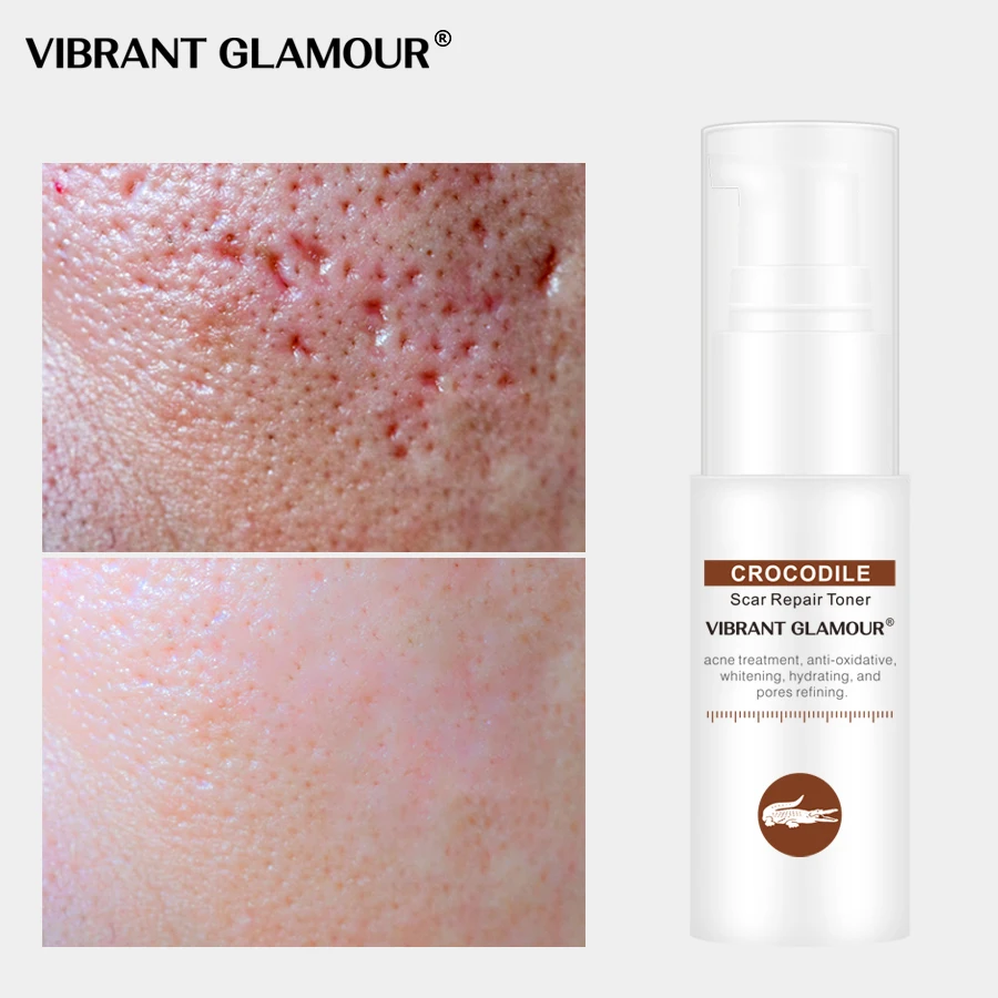 Vibrante GLAMOUR cocodrilo cara Toner reparar cicatriz suero de acné reducir los poros iluminar aliviar sensible cuidado de la piel 30ML