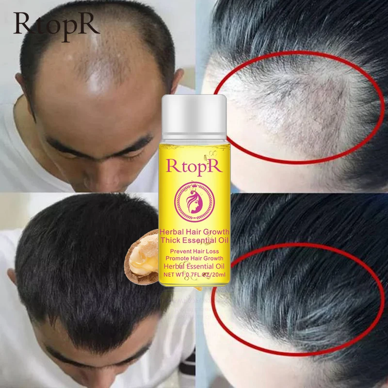 

RtopR Herbal Hair Growth Essential Oil Nourish Hair Roots Repair Loss Dry Hair Treatment Promote Fast Hair Growth Liquid