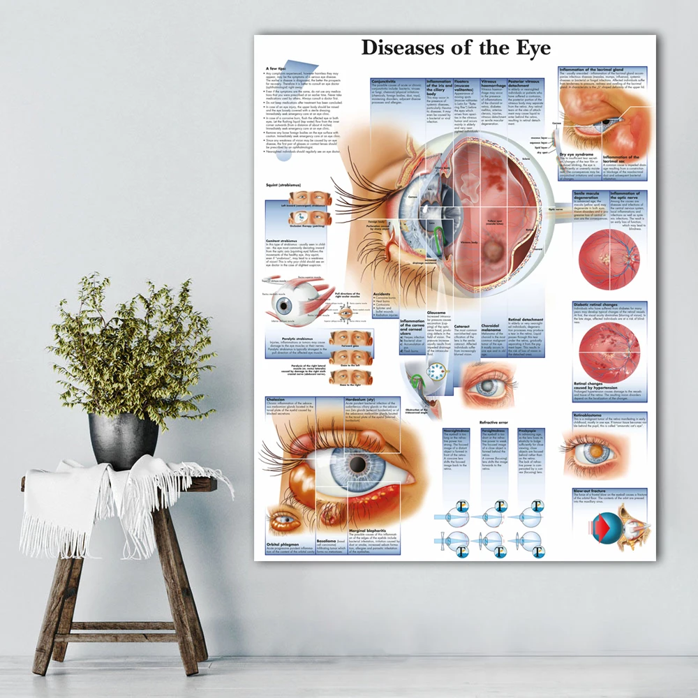 Günstig WANGART Poster Krankheiten der Eye Chart Poster Refractiv Leinwand druck Wand Bilder für Medizinische Bildung Wohnkultur