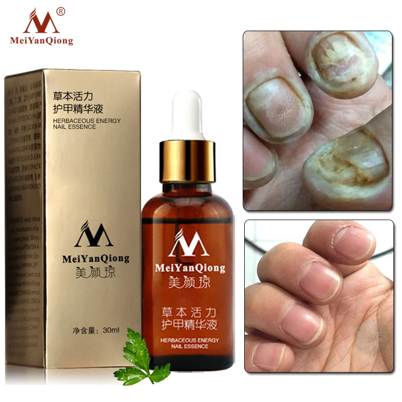 

MeiYanQiong Fungal Nail Treatment Feet Care Essence Removal Gel Anti Infection Paronychia Nail Foot Whitening Toe Fungus 30ml