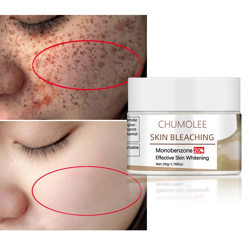 Осветляющий крем для кожи Chumolee отбеливающий лица монобензон 20% Vitiligo темные пятна