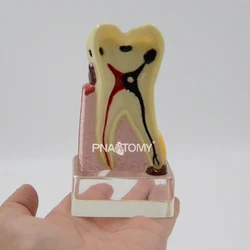 Dentes doentes ampliados modelo saprodontia decaiu dente nervo dental anatômico oral modelo educacional equipamento ferramenta de ensino