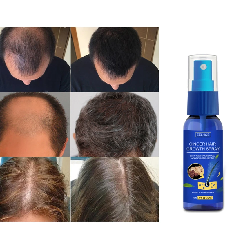 Eelhoe 30ml Ginger Hair Growth Spray Anti Hair Loss Hair Growth Spray