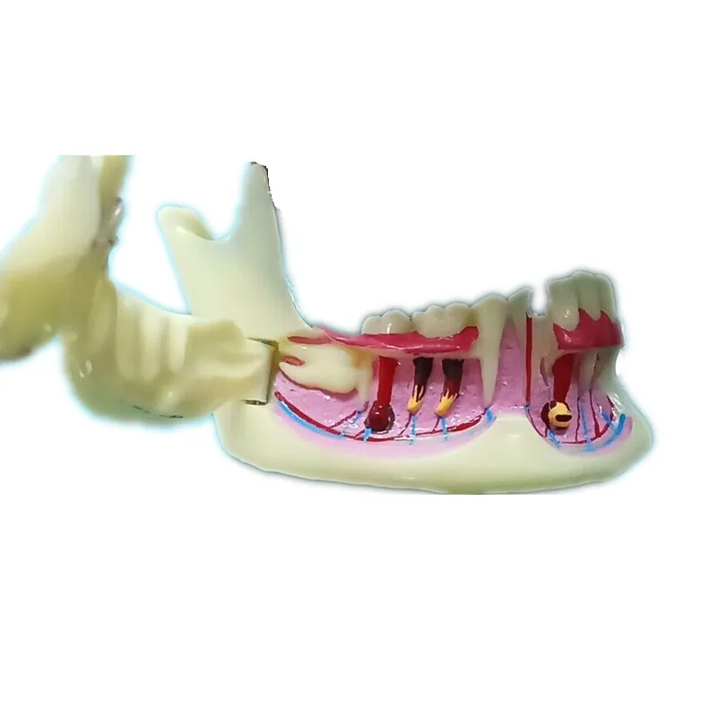 

Dental mandible model Anatomy of gums Teeth Model showing impaction caries and abscess dental teaching model