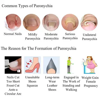 

Ingrown Toenail Correction Sticker Ingrowing Nail Correction Foot Orthopedic 100Pcs Patch Nail Tool Care Patch Correction S N4X6