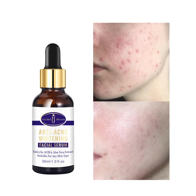 

Anti-Acne Whitening Facial Serum Fade Acne Dark Spots Moisturizing Soothing Face Essence Oil-Control Shrink Pores Skin Care 30ml