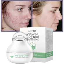 Effective Anti-acne Cream, Acne, Acne, Fade, Acne Marks, Oil Control, Pore Shrinkage, Whitening, Moisturizing, Acne Cream