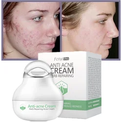 Effective Anti-acne Cream, Acne, Acne, Fade, Acne Marks, Oil Control, Pore Shrinkage, Whitening, Moisturizing, Acne Cream