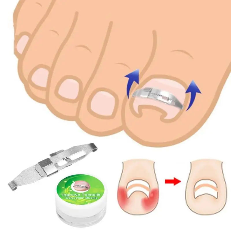Metal Ingrown Toe Nail Correction Wire Fixer Pedicure Paronychia Recover Toenails Corrector Foot Care Tool