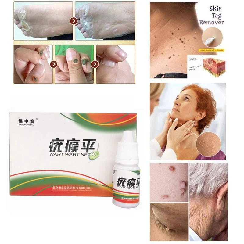 Black Dots Mole Wart Skin Tag Remover 12 Hours Tu Kill Liquid Medical Foot Corn Removal Care Solution|Автозагары и бронзаторы