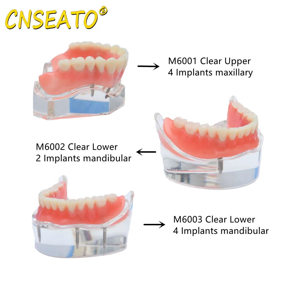 

CNSEATO 1 PC Dental Implant Teeth Model Demo Overdenture Typodont Restoration Model 2/4 Implants Upper&Lower M6001