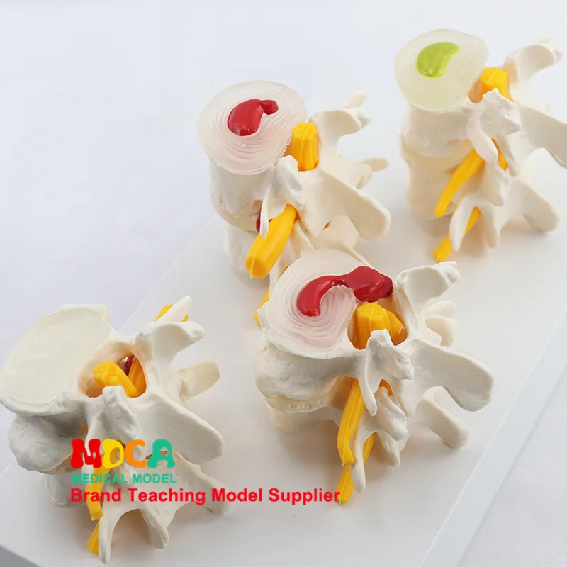 

Human Skeleton Orthopedics Teaching Spine Model Lesions Lumbar Vertebra Model Medicine Teaching Myz005