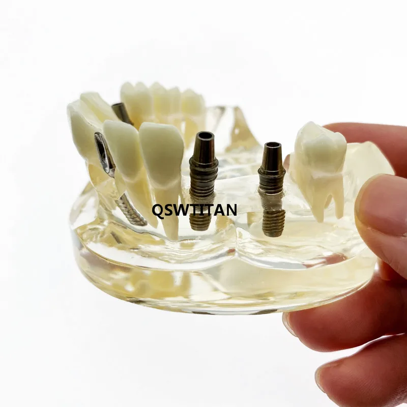 Modelo dentário com ponte e cavidades, modelo para implante dentário