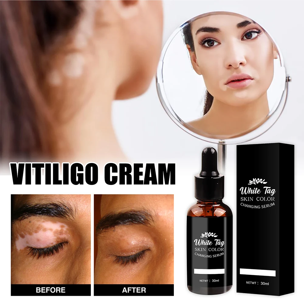 applaudire Nazione Escursione autoabbronzante vitiligine Malawi