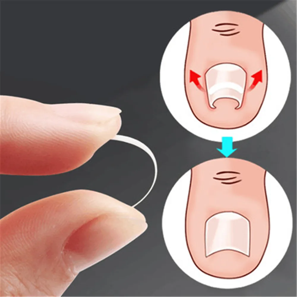 Ingrown Toenail Correction Tool 10pcs Ingrown Toe Nail Treatment Elastic Patch Sticker Straightening Clip Brace Pedicure Tool