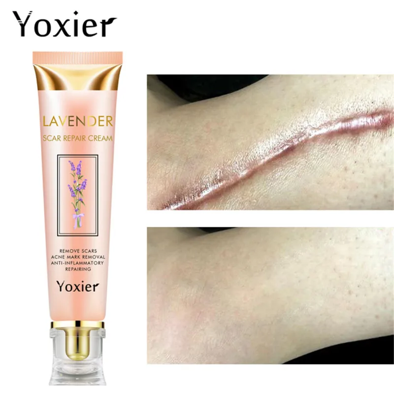 

Yoxier Repair Scar Cream Acne Scar Stretch Marks Skin Care Pigmentation Corrector Anti-allergic Calm Whitening Face Cream 1pcs