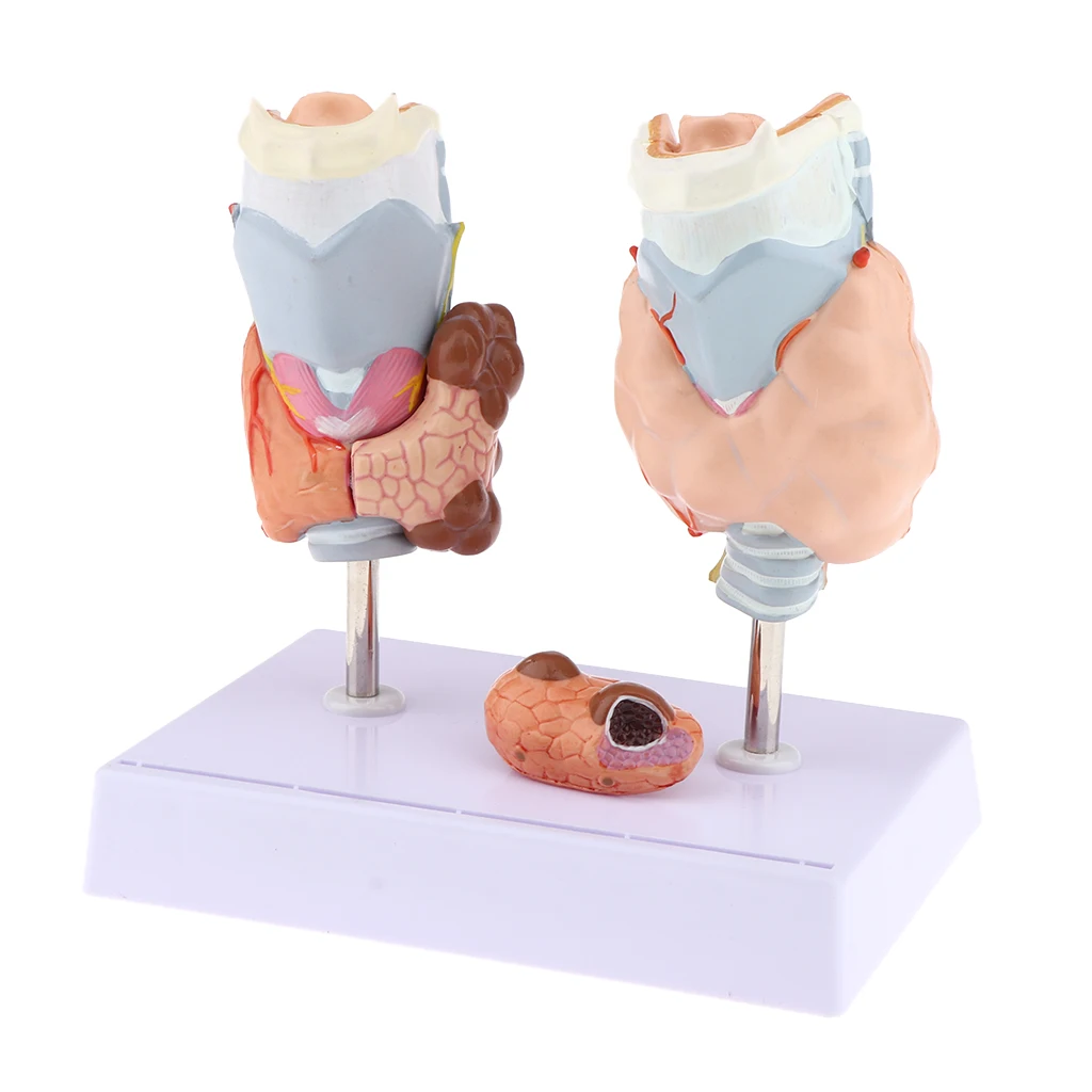 Human Anatomical Thyroid Gland Pathology Anatomy Medical Teaching Model - Lab Supplies Science Classroom Education