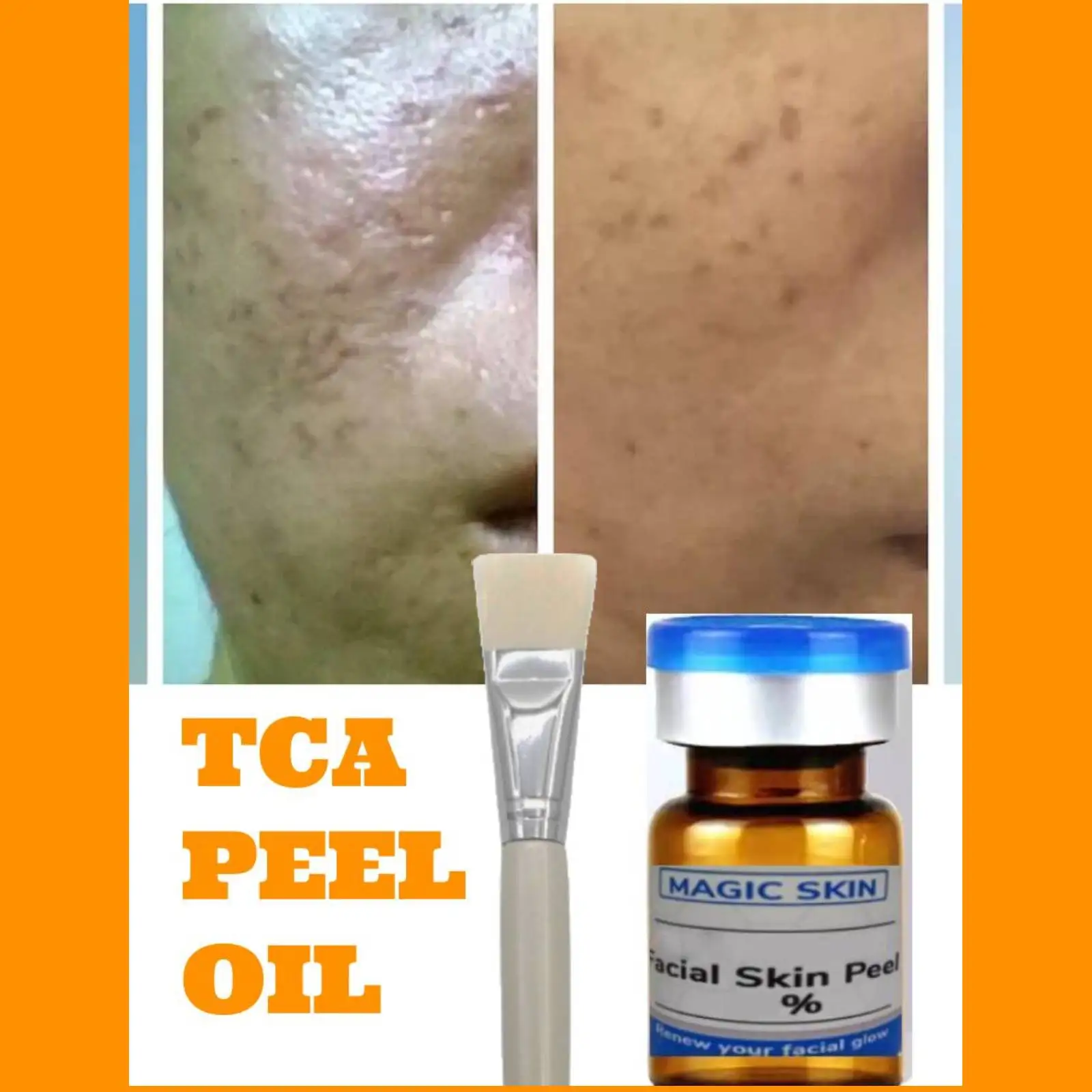 

Tca Peeling Oil Perfect Chemical Peel Exfoliating DEEP SEASONED USERS Scars, Marks, Pigment, POCKMARKS, Acne Tca Cross Peel