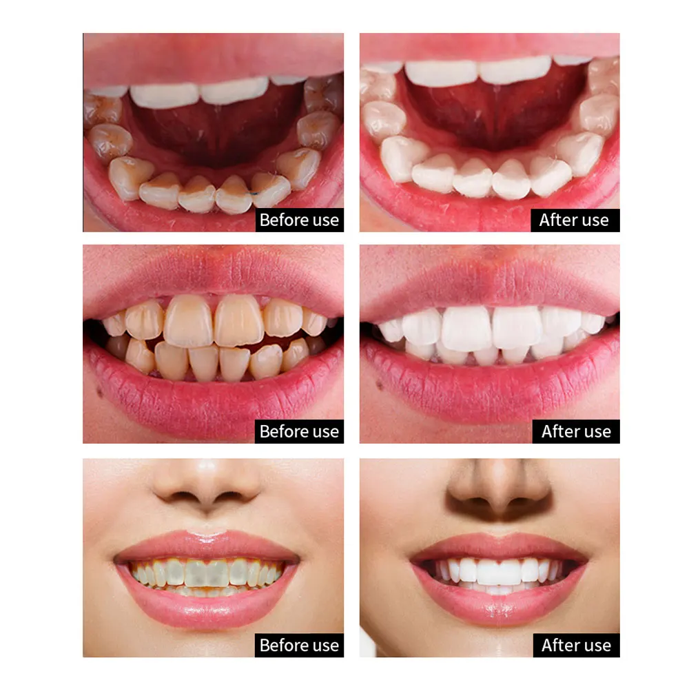 ARTISCARE отбеливание зубов эссенция 5 шт. гигиена полости рта Очищающая сыворотка