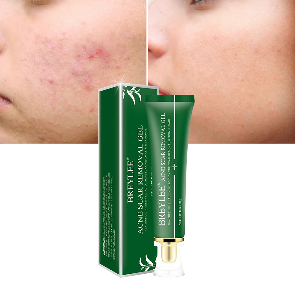 BREYLEE Scar Removal Gel Anti Acne Pimple Removal Repair Sooth Essential Oil