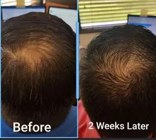 Esencia De rápido crecimiento De pelo, productos Para la pérdida del cabello, Fibras Para el crecimiento del cabello, champú, crema De tratamiento Para el cuidado del cabello