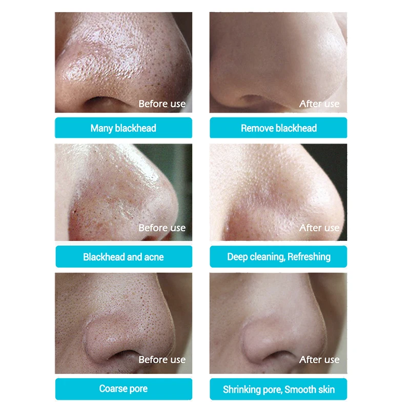 LANBENA маска для носа средство удаления черных точек полоска очищения пор черная