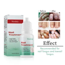 Лечение грибков ногтей противогрибковое удаление онихомикоза Уход за ногтями ремонт жидкий гель для удаления грибка ногтей