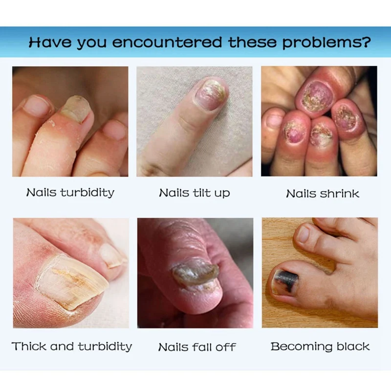 Жидкость для восстановления ногтей устранение грибка для удаления онихомикоза для ухода за ногтями-i
