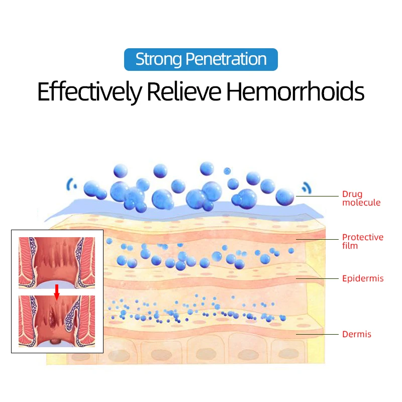 Hemorróidas almiscaradas supositório remoção hemorróidas tratamento pilhas