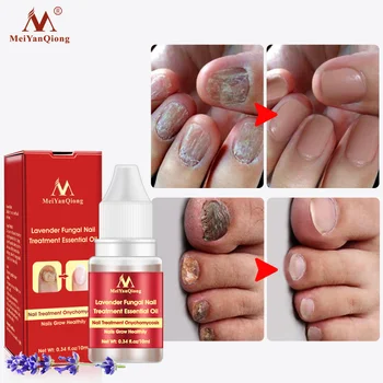 

10ml Nail Fungus Treatment Anti Fungal Toenail Repair Care Lavender Essential Oil LDO99