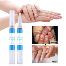 Гель для ремонта ногтей удаляет онихомикоз против инфекции китайская травяная жидкость эффективно лечит колючий червь