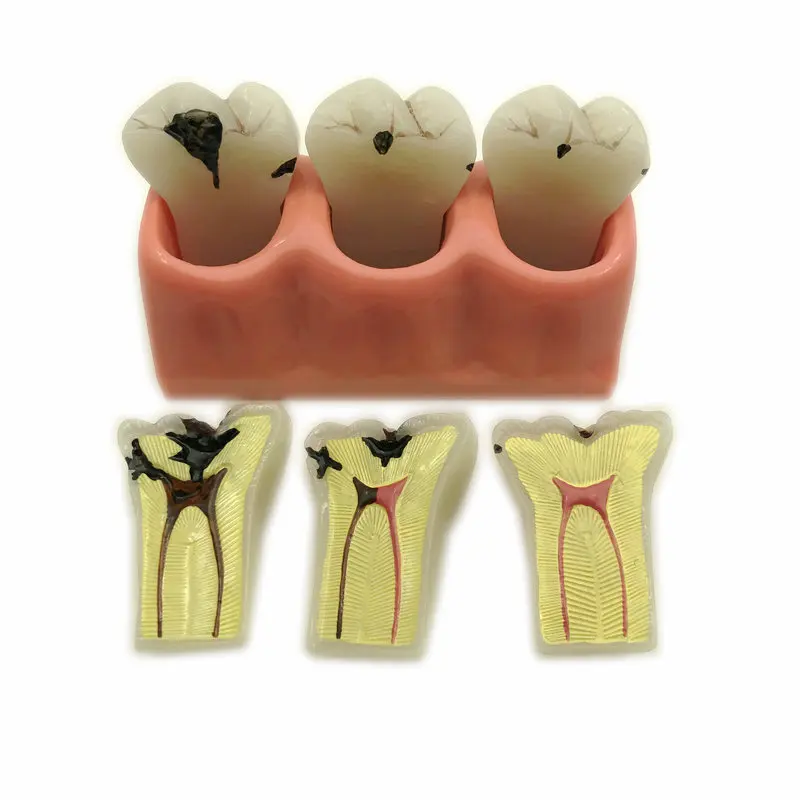 

4 Times Caries Decomposition Model Dental Patient Education Study Teeth Model