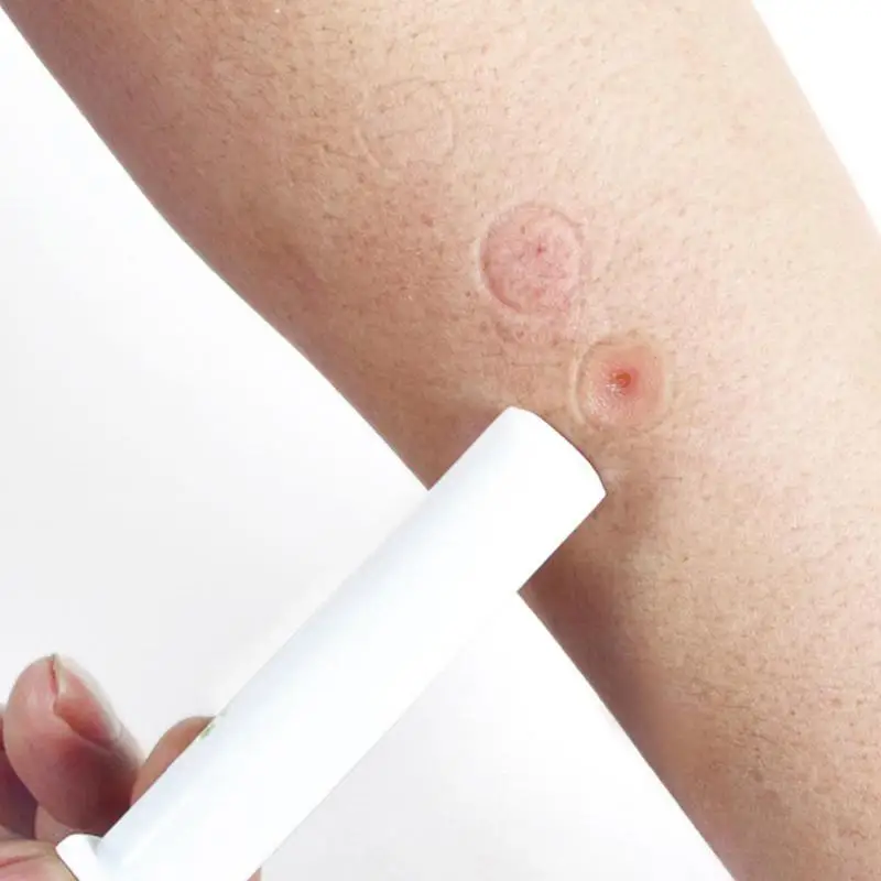

New Mosquito Bites Extraction Vacuum Pump Reduce the Itching Swelling First Aid Snake Venom Extraction Vacuum Pumps