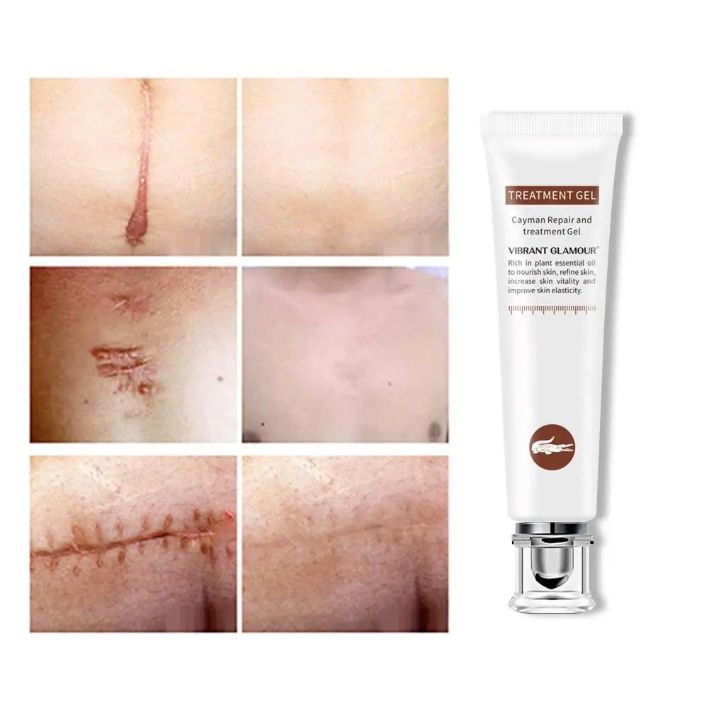 Scar Removal Cream Gel For Face Acne Scar Stretch Marks Remover Cream Skin Repair Face Cream For Burns Dilute Scars Skin