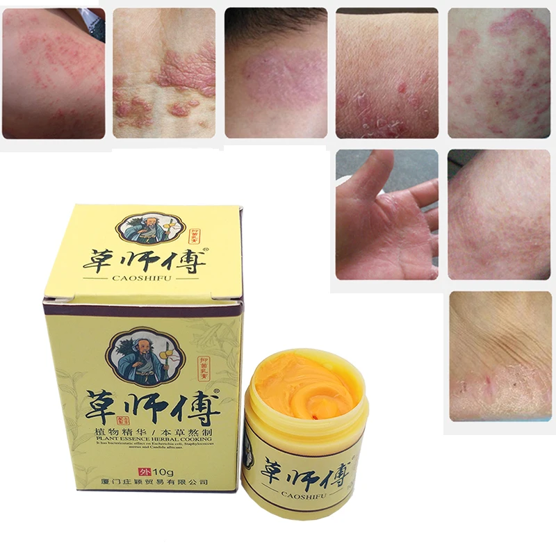 1pc Skin Psoriasis Cream Dermatitis Eczematoid Eczema Ointment Treatment Psoriasis Cream Skin Care Cream 10g