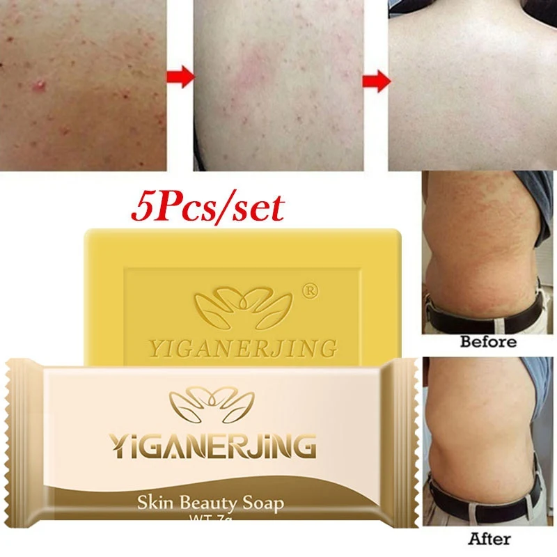 5pcs Sulfur Soap add Psoriasis Cream Dermatitis Eczematoid Eczema
