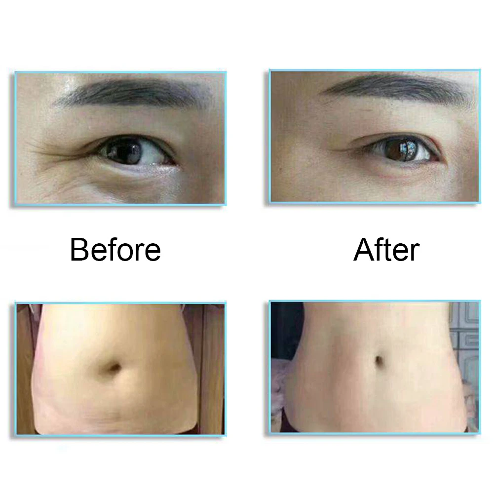 Гиалурон ручка Регулируемый распылитель высокого давления против морщин мезотерапия карандаш