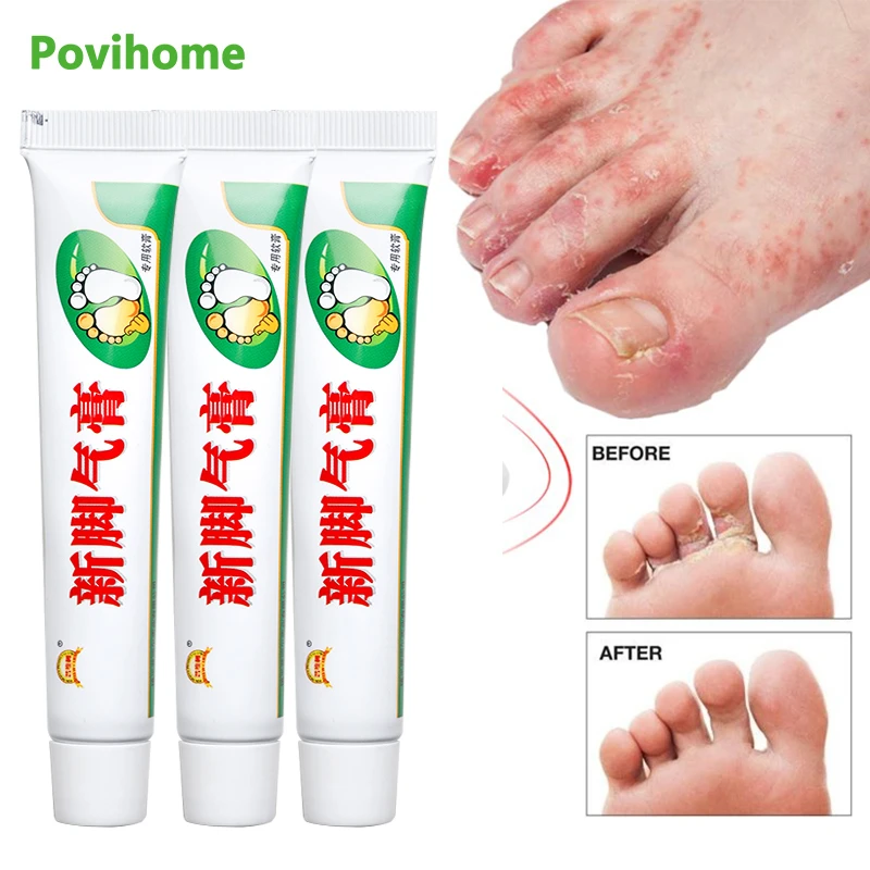 Skin Allergy Itching Fungal Anti Ringworm Seborrheic Dermatitis