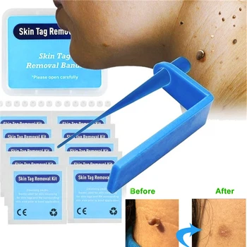 

Micro Band Non Toxic Face Care Mole Wart Tool For Small To Medium Blue Skin Tag Removal Kit With Cleansing Swabs Home Use Adult