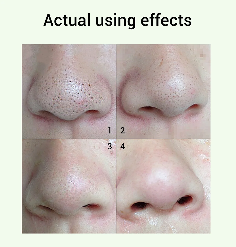 Blackhead Remover Peel Off Nose Mask Face Serum For Anti Acne Treatment Black Head Removal Pore Refining Serum Shrinks Pore Kit 006