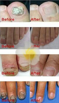 OEDO Nail Treatment Essential oil Hand and Foot Onychomycosis Toe Nail Fungus Removal Infection Feet Care 30ml OEDO Nail Treatment Essential oil Hand and Foot Onychomycosis Toe Nail Fungus Removal Infection Feet Care 30ml