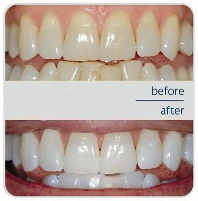 

Natural White 5 Minute TOOTH WHITENING SYSTEM Kit Gel and Tray
