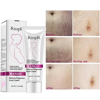 

2019 Natural Mild Non-irritating Mango Stretch Mark Cream For Pregnancy Repair Scar Slack Line Abdomen Stretch Marks Cream TSLM1