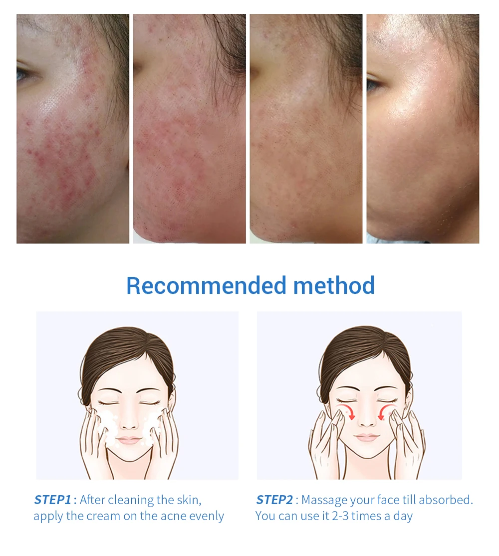 LANBENA маска для лица серия Acne Уход за кожей Гиалуроновая кислота сыворотка акне прыщи патч лечение акне гель для удаления прыщей крем для лица